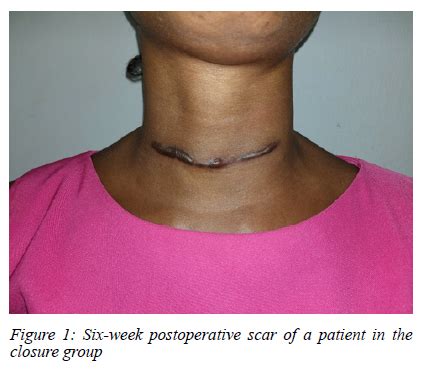 The Impact Of Non Closure Of The Platysma Muscle Layer On The Cosmesis