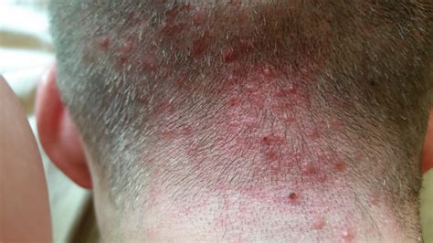 Scalp Acne Folliculitis Pictures General Acne Discussion Acne Org