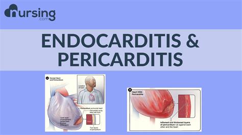 Lets Break Down These Two Big Words Endocarditis And Pericarditis