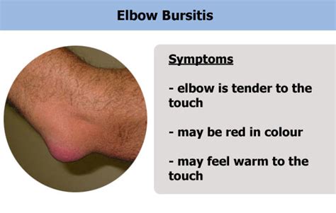 Bilateral Elbow Pain Human Body Anatomy