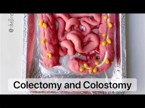 Playdough Surgery Colectomy Colon Removal And Colostomy Creation