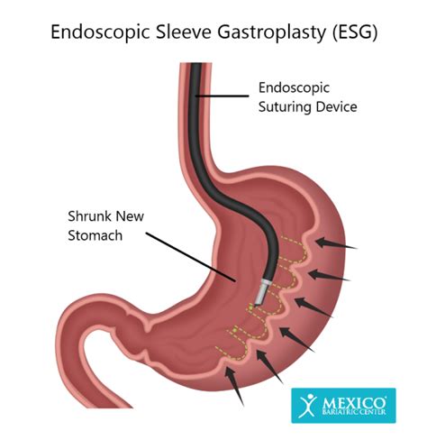 Endoscopic Sleeve Gastroplasty Esg In Mexico Mexico Bariatric Center