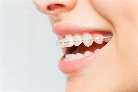 5 Must Have Tools If You Have Braces L Willow Bend Orthodontics