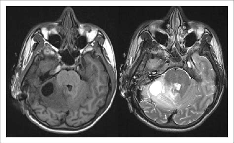 Magnetic Resonance Imaging Mri T1 Left And T2 Weighted Right