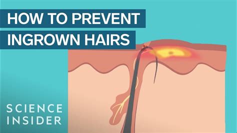 What Are Ingrown Hairs And How To Treat Them YouTube