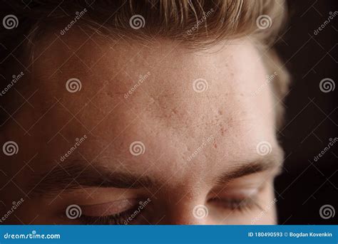 Acne Scars On The Face Stock Image Image Of Medical 180490593