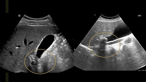 Gallbladder Anatomy Ultrasound