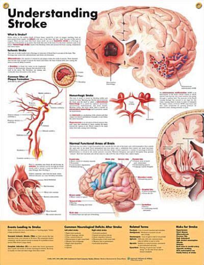 Understanding Stroke Chart 20x26 Neurology Medical Anatomy