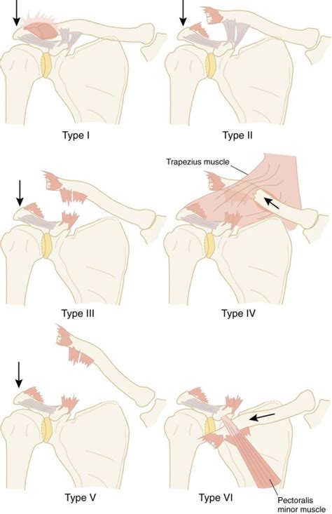 Acromioclavicular Joint Injuries And Sternoclavicular Joint Injuries