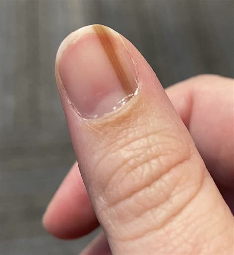 Signs Of Melanoma In Nails Home Design Ideas