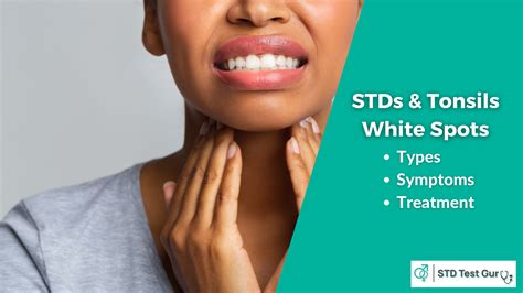 Stds And White Spots Tonsils Types Oral Std Symptoms Treatment