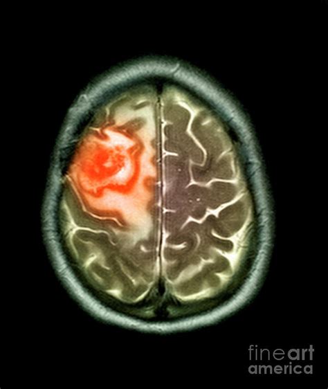 Secondary Brain Cancer Photograph By Simon Fraserscience Photo Library