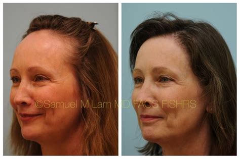 A certain amount of hair loss, about 100 hair strands a day, is women aged 25 to 35 years are more susceptible to severe hair loss while mild to moderate hair loss is not uncommon in older women. This 54-year-old woman underwent female hairline lowering ...