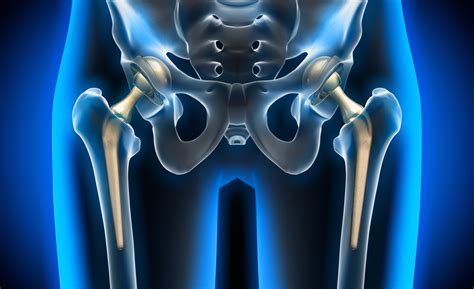 Prevent Hip Replacement Dislocation