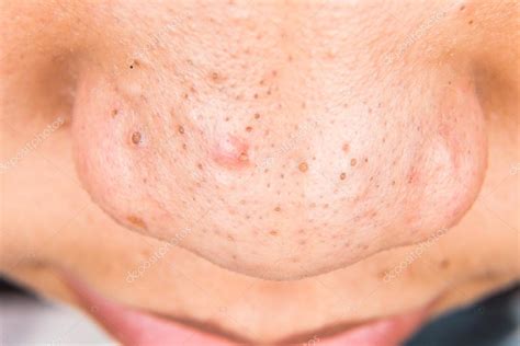 Closeup Of Pimple Blackheads On The Nose Of A Teenager Stock Photo By