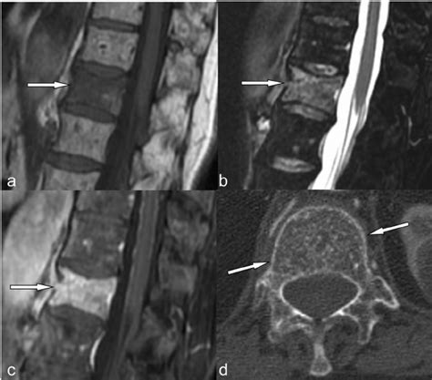 Atypical Mr Imaging Features Of Vertebral Hemangioma Involving The T12
