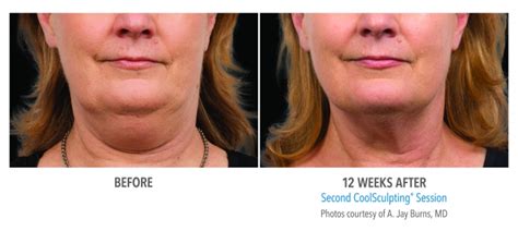 Coolsculpting Face Neck Before And After Photos Nyc
