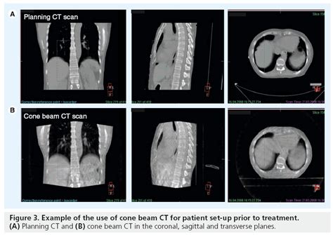 Image Guided Radiotherapy For Esophageal Cancer