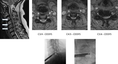 Severe Central Canal Narrowing And Multilevel Cervical Exit Foraminal Download Scientific