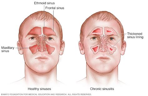 Acute Sinusitis Disease Reference Guide Drugs Com