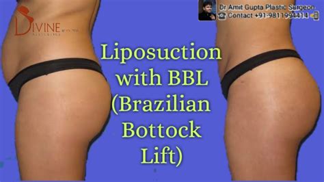 Liposuction With Bbl Brazilian Bottock Lift Youtube