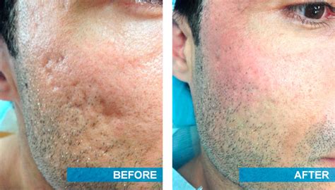 regaining confidence with acne scar treatment dermatology consultants of frisco