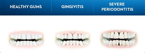 What Is Gingivitis Explained Here Divine Dental Care Riset