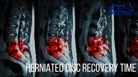 Herniated Disc Recovery Time Youtube