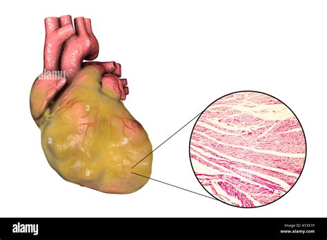 Ilustración De Un Corazón Graso Con Hipertrofia Ventricular Izquierda Y