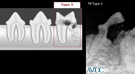 Feline tooth resorption (tr) is a syndrome in cats characterized by resorption of the tooth by odontoclasts, cells similar to osteoclasts. Tooth resorption in dogs and cats - VetBloom blog
