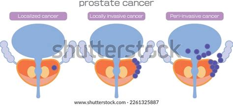 Illustration Showing Progression Prostate Cancer Stock Vector Royalty Free