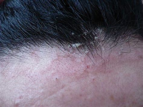 Dry Flaky Skin Behind Ears Toxoplasmosis