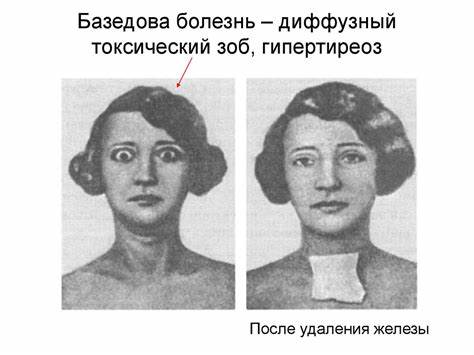 Зоб диета лечение Гормоны гипофиза и их органы-мишени - online presentation Гормоны гипофиза и их органы-мишени - online presentation Зоб диета лечение