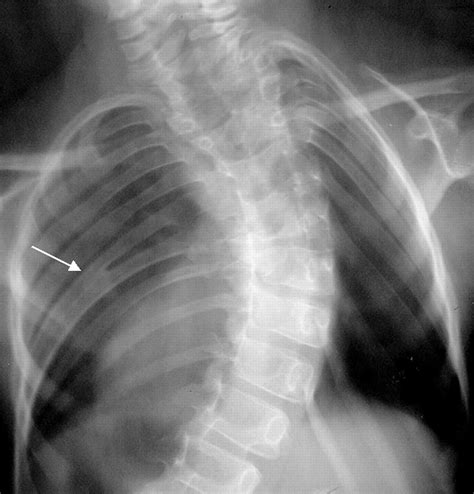 Congenital Anomalies Of The Ribs And Chest Wall Associated W Jbjs