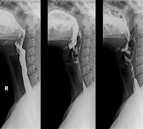 Barium Swallow X Ray Of The Throat