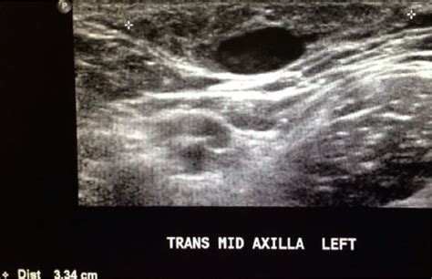 Variation In Galactocele Location And Sonographic Appearance Madlyn R