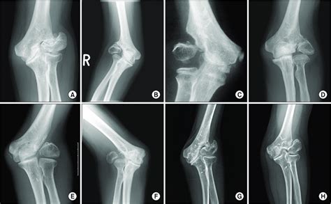 A H Radiographs Of All Cases Of Non United Lateral Condyle Humerus