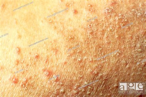 Pityriasis Rubra Pilaris Stock Photo Picture And Rights Managed Image