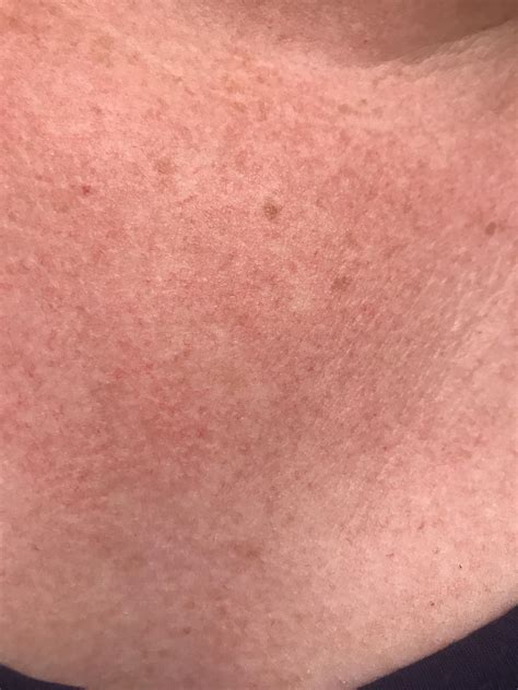 Skin Concerns Is There Anything Thatll Get Rid Of The Redness On My