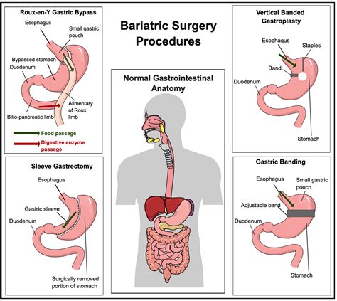 Bariatric Surgery Complications Nlevy Acherney Thomas Jefferson