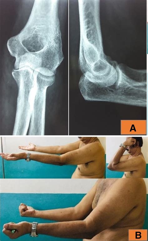Anterior Elbow Dislocation Without Fracture In An Adult A Rare Injury