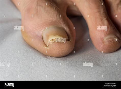 Trauma Injury To Toenail Due To Tightly Fitting Sports Shoes Leading To