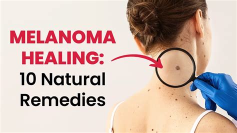 Natural Remedies To Clear Melanoma Youtube