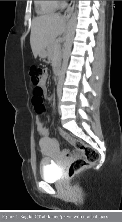 Figure 1 From Robotic Assisted Laparoscopic Partial Cystectomy For