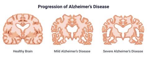 Alzheimers Disease Symptoms Causes Treatment And 7 Stages Health