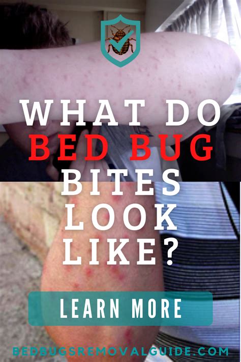 What Do Bed Bug Bites Look Like In 2022 Bed Bug Bites Bed Bugs Bug