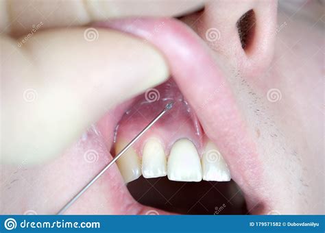 Dental Anesthesia In The Dentist S Chair Needle Of Dental Syringe