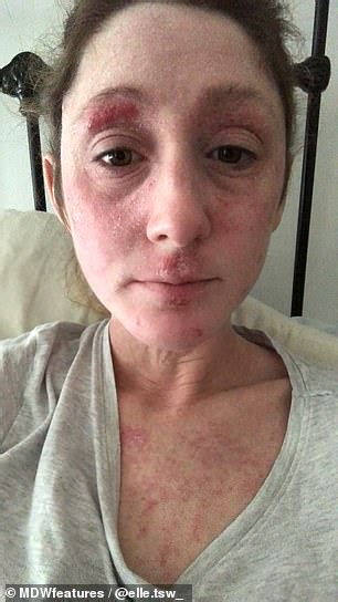 Woman With Severe Eczema After Steroid Withdrawal Claims Doctors Laugh