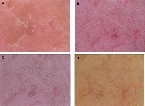 Figure From Chronology Of Lichen Planus Like Keratosis Features By