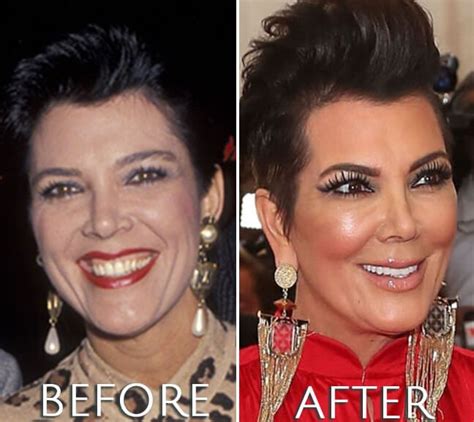 Kris Jenner Before And After Plastic Surgery Cirugía Plástica Famosos